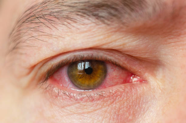 Signs of Eye Diseases: Red or Watery Eyes