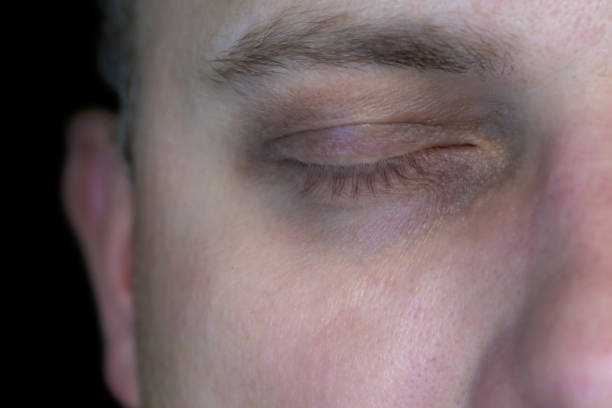 Dark Circles