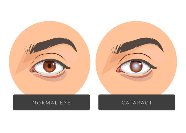 Cataracts