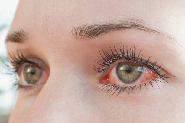 Prevent Common Eye Diseases