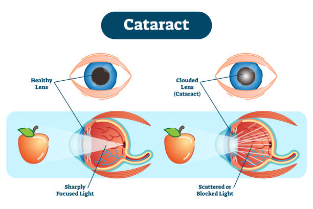 Cataracts Explained: Causes, Symptoms, and Treatment Options