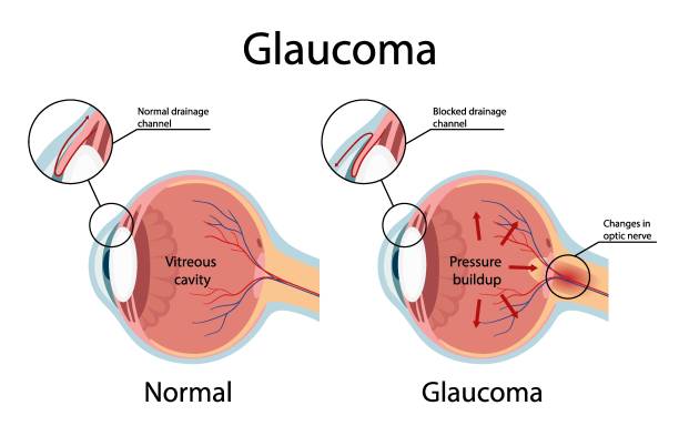 Glaucoma: What You Need to Know to Protect Your Vision