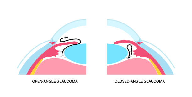 Glaucoma