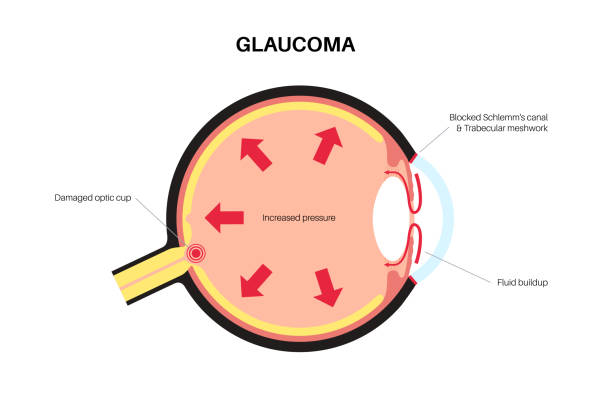 Glaucoma