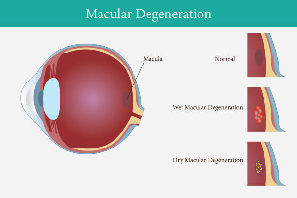Macular Degeneration Prevention: Simple Lifestyle Changes